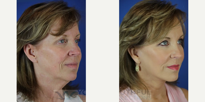 45-54 year old woman treated with Facial Fat Transfer, Facelift - Procedures Performed:Fat TransferFacelift / Reflection Lift