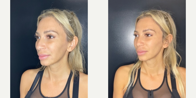 35-44 year old woman treated with Dermal Fillers - 1 syringe of RHA Redensity to soften the nasolabial folds.