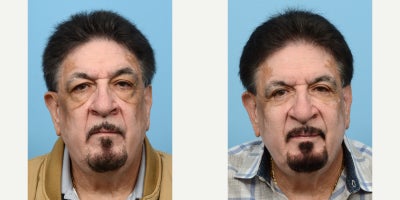 65-74 year old man treated with Eyelid Surgery, Double Eyelid Surgery - This patient was complaining of aging eyes, excess skin on around upper eyelids and had lower eye bags, puffiness, along with malar festoons. Dr. Wise performed an upper and lower blepharoplasty to remove excess fat and skin, and to tighten the skin and alleviate the look of the folds.