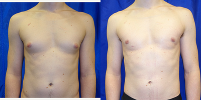 25-34 year old man treated with Gynecomastia surgery - This fit 31 year old man had unwanted growth of glandular tissue in his chest. He underwent surgical removal using a liposuction-based approach, removing the fat and glandular tissue through minimal incisions, giving him a more masculine chest contour.