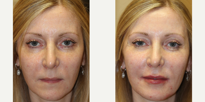 35-44 year old woman treated with 2 syringes of Restylane - This patient was treated with 2 syringes of filler. The after photo was taken immediately post injections.