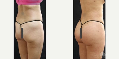 Woman treated with Butt Implants, Brazilian Butt Lift, Renuvion - Woman treated with Butt Implants, Brazilian Butt Lift, Renuvion