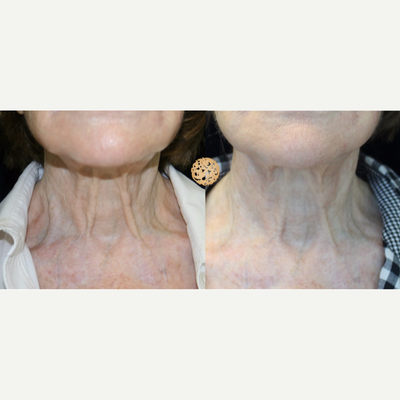 75 and up year old woman treated with Pelleve - 90 Year old patient after four Pelleve treatments.