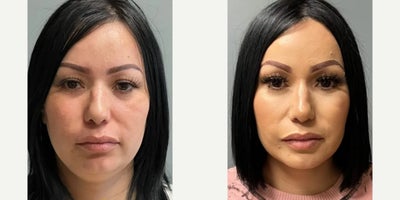 Woman treated with Neck Lift - Woman treated with HiDef Deep Plane Neck Lift as well as Facial Fat Transfer through lipocube