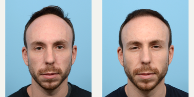 25-34 year old man treated with FUE Hair Transplant, Hair Transplant, Hair Loss Treatment, PRP for Hair Loss, NeoGraft - This 34-year-old patient was concerned with his rapidly receding hairline. Since he likes to keep his hair short, he opted for an FUE Hair Transplant with Dr. Wise, knowing he will have no visible scars as a result of this procedure. The patient also underwent PRP therapy on the day of the procedure to strengthen viable hairs. Six months after receiving 2,525 grafts to his hairline, he's amazed by his restored hairline. Full results will be available around the one year mark.