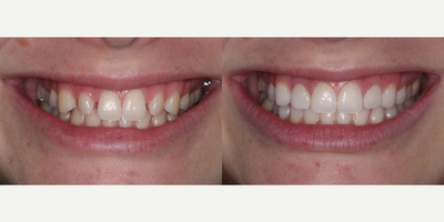 Bonding and Bite Alignment - Conservative bonding was done to close gaps and better align the bite. Function and esthetics are both restored. This was done without removal of any tooth structure  and did not require anesthesia.