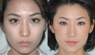 18-24 year old woman treated for Asian Rhinoplasty - 22-year-old woman, nose and chin surgery, post operative 8 years after surgery. Nose surgery with silastic bridge and cartilage to tip. Chin implant. Left eye DST non incision double eyelid surgery. Eight year follow up. Silastic implants are generally well tolerated along the bridge in Asian patients.
