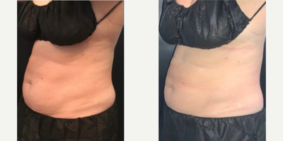 45-54 year old woman treated with truSculpt 3D, truSculpt iD - Custom body contouring using TruSculpt. 1.5 inches down!