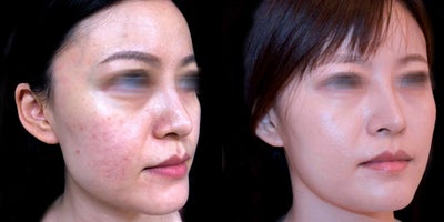 18-24 year old woman treated with Pulsed Dye Laser - This patient wanted to address redness due to acne. She underwent a series vascular laser treatments with Dr. Khorasani.