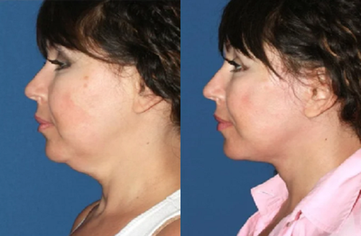45-54 year old woman treated with Neck Lift - This patient presents with concerns of sagging neck skin and jowls. Good skin quality full cheeks make her an excellent candidate for facial rejuvenation. Face and neck lift was performed to restore the contour of the neck and jawline resulting in a significantly rejuvenated appearance.