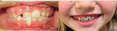 3 Month Progress Phase I - This young girl had Phase I treatment to treat a tooth in crossbite - check out this 3 month progress photo!