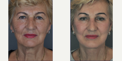73 year old woman treated with Facelift Revision - The patient underwentrevision facelift (deep plane), upper blepharoplasty,TCA peeling, 1 year postoperatively