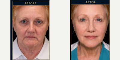 55-64 year old woman treated with Nonsurgical Facelift - MIPPS Face (Minimally Invasive Precision Plication Suspension Facelift)What is MIPPS Face?MIPPS Face is an advanced minimally invasive facelift technique designed to restore a more youthful, refreshed appearance with significantly less downtime than a traditional facelift. The procedure focuses on lifting and repositioning facial tissues through small, strategically placed incisions while minimizing tissue disruption.Unlike procedures that simply tighten the skin, MIPPS Face addresses the underlying facial structures responsible for sagging, jowls, loss of jawline definition, and facial aging. By elevating and securing deeper support tissues, the procedure creates natural-looking rejuvenation while preserving each patient's unique facial characteristics.Benefits of MIPPS FaceMinimally invasive approachSmaller incisionsReduced recovery timeImproved jawline definitionReduction of jowls and facial saggingMore youthful facial contoursNatural-looking resultsCan be performed under local anesthesia in many casesLess bruising and swelling compared to traditional facelift techniquesIdeal CandidatesMIPPS Face may be appropriate for men and women experiencing:Mild to moderate facial saggingEarly jowl formationLoss of jawline definitionNeck laxityFacial volume descent associated with agingDesire for facial rejuvenation without undergoing a more extensive traditional faceliftRecoveryMost patients experience temporary swelling and bruising that gradually improves over the first few weeks. Because MIPPS Face utilizes a minimally invasive approach, many patients return to social activities sooner than they would following a conventional facelift procedure.ResultsPatients often notice an immediate improvement in facial contour and definition, with continued refinement as swelling subsides. Results are designed to appear refreshed and natural rather than overly tight or artificial.Important NoteEvery patient ages differently, and candidacy for MIPPS Face is determined during a personal consultation. The procedure is customized to each individual's facial anatomy, skin quality, and aesthetic goals to achieve the most natural and balanced outcome possible.MIPPS Face is designed to help patients look younger, more rested, and more confident while minimizing downtime and maintaining a natural appearance.