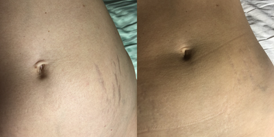 40-45 year old woman treated with Opus Plasma - After 1 Opus treatment and 2 Aerolase treatments