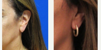 Earlobe Repair - Dr. Eric Schaffer fixed the elongated earring hole in earlobe with local anesthesia and then re-pierced it 3 months later.