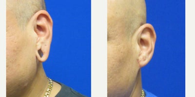 Gauge Earlobe Repair - Patient wanted to have his earlobe gauges closed and repaired. Dr. Eric Schaffer repaired his earlobes in the office under local anesthesia.