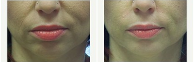 35-44 year old woman treated with Perlane - 41 year old female underwent filling of her nasolabial folds with 1 syringe of Perlane. The procedure was performed by Dr. Rottman.