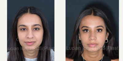 18-24 year old woman treated with Asian Rhinoplasty - This kind lady was concerned regarding the projection of the nasal bridge and nasal tip, in combination with the width of the tip from the front, as well as the nasal length .An ultrasonic hybrid reduction rhinoplasty was carried out to decrease the bridge projection but maintain dorsal aesthetic lines and it was combined with rotation of the nasal tip.