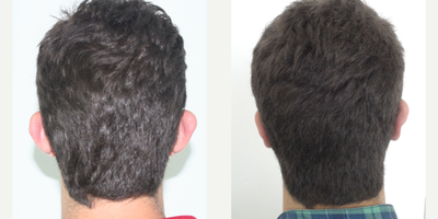 25-34 year old man treated with Ear Surgery - Ear Pinning surgery performed by DR. OZGE ERGUN. (This is the result of 1 month post operative)