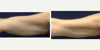 65-74 year old woman treated with Radiesse, Dermal Fillers, Exilis - Excellent combination of two techniques. Biostimulation with radiesse and potentiation with Exilis.