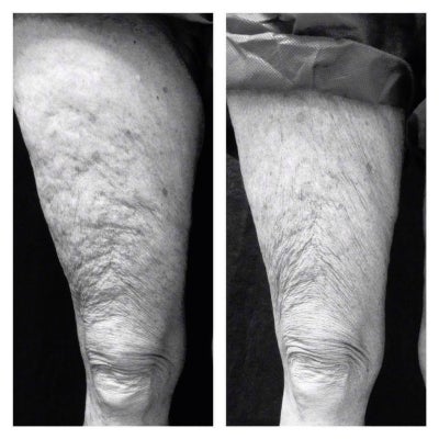 55-64 year old woman treated with Infini RF for improving leg skin laxity - This is 3 months after one treatment with Infini for skin laxity of the legs.