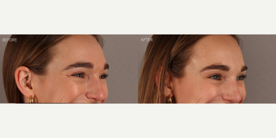 Upper Facial Botox (Forehead, 11's, Crows Feet) - 29-year-old female who requested conservative Botox treatment to address upper facial wrinkles of expression. Conservative dosing was used to preserve facial movement but reduce wrinkling. She is shown two weeks post-treatment.