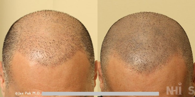 35-44 year old man treated with Scalp Micropigmentation - Scalp Micropigmentation