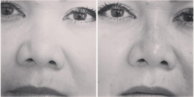 Woman treated with Rhinoplasty - Woman treated with Rhinoplasty