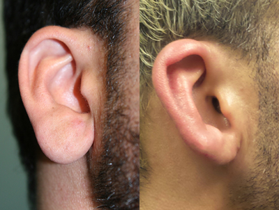 35-44 year old man treated with Earlobe Surgery - This patient was unhappy with large earlobes. He was treated with earlobe reduction surgery.