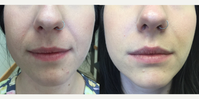 35-44 year old woman treated with Teosyal - Teosyal Filler to Nasolabial folds