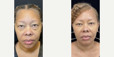 49 year old woman treated with Eyelid Surgery, Facial Fat Transfer - 49 year old woman treated with Eyelid Surgery, Facial Fat Transfer
