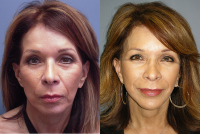 Lite Lift - 
	This 59-year-old woman had a Lite Lift. The Lite Lift is a variety of mini facelift that reduces signs of aging around the jaw, neck and lower face.
