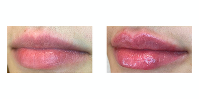 25-34 year old woman treated with Lip Fillers - For lips voluminization an application of hyaluronic acid is performed with personalized techniques to restore or give volume and elasticity in a natural way to the lips, always respecting naturalness and avoiding excesses or very voluminous lips.  The results are progressive, they are seen from its application but after 15 days the final result is reflected.