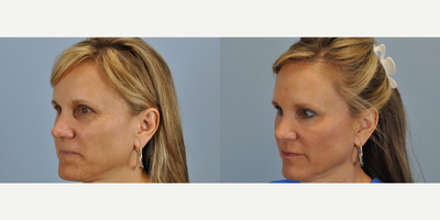 50 year old woman treated with Radiesse, Botox, and Juvederm - This 50 year old patient was treated with Radiesse, Botox, and Juvederm.