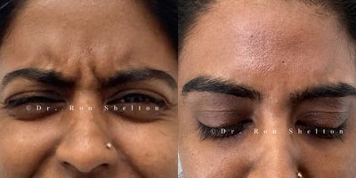 35-44 year old woman treated with Jeuveau, Skin Tightening - 36 year old woman treated with Jeuveau for frown lines. Notice her frown lines before the treatment and 2 weeks after Jeuveau patient is trying to frown but frown lines are not visible.