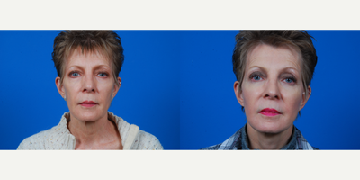 55-64 year old woman treated with Facelift, CO2 Laser - Bilateral facial rhytidectomy. Bilateral facial microfat graft placement bilateral malar and cheek area, bilateral temporal area, and bilateral nasolabial fold area. Perioral Co2.