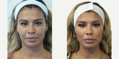 37-Year-Old After Silhouette InstaLift - This 37-Year-Old wanted to lift her cheeks, make nasolabial folds less prominent and improve the overall contour of her face. She underwent Silhouette Instalift procedure. Silhouette InstaLift is a non-surgical thread lift that uses Micro-Suspension Technology. It Immediately lifts mid-facial skin, including sagging cheeks and deeper nasolabial folds, and boosts volume by activating natural collagen production over time.