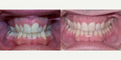35-44 year old man treated with Clear Braces - Treated with Upper/Lower brackets and surgery.