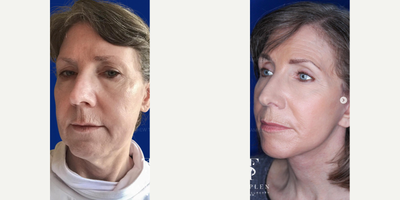 Woman treated with CO2 Laser - Beautiful result just 3 months after deep plan #facelift and Co2 laser resurfacing.Her mid face has been treated, jowls are gone and neckline is beautiful! Elegant & natural results that we love.