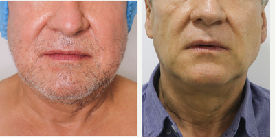 55-64 year old man treated with Buccal Fat Removal - This a minimally invasive cosmetic procedure to remove excess fat from the chin and neck area, resulting in a more defined, sculpted appearance. This procedure is often sought by patients who are dissatisfied with the appearance of a double chin or a less defined jawline due to excess fat deposits.
