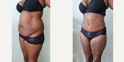 35-44 year old woman treated with Tummy Tuck, Liposuction - This 40 yo mommy who had a Tummy Tuck with Lipo 360 showing her before and 5 months after pics post op. We removed 1.5kg from her tummy and safely suctioned 3L of fat from upper tummy, flanks and back to give her a nice contour fitting to the rest of her body  including a cute new belly button and the famous Champagne Groove on the upper part of her tummy.
