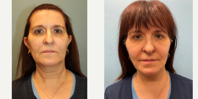 55-64 year old woman treated with Lower Facelift - This 58 year old patient is acutally a team member of ours who has been wanting a face lift. She wanted to improve her jowls, neck and jaw line. One month post-op, she already has a beautiful, natural result. Her neck, jowls and jaw line are all imporved and she is thrilled with the results.