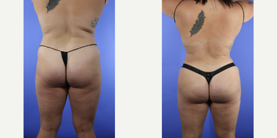 25-34 year old woman treated with Liposuction, Brazilian Butt Lift - Patient is 3 months post liposuction 360 with fat transfer to the hips and buttock. She looks natural. Patient couldn't be happier with her results. She looks amazing!