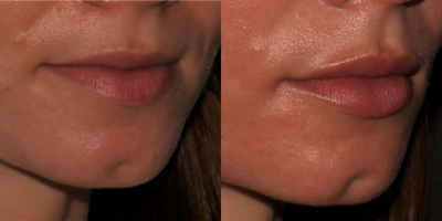 18-24 year old woman treated with Lip Fillers, Dermal Fillers - 1/2 Syringe of Teosyal Redensity 2