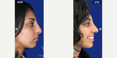 Woman treated with Revision Rhinoplasty - This patient can't stop smiling and neither can we! She unfortunately did not get the outcome she wanted from her initial #rhinoplasty surgery by another surgeon & was unhappy with the continued size and deviation of her nose.She was also struggling with nasal breathing. Specializing entirely in the face, I have become experienced with revision rhinoplasty and know what it takes to provide beautiful results like thisevery time.I was able to use the cartilage remaining in her nose to support it so that she can breathe while also giving her the elegant tip definition she always wanted.