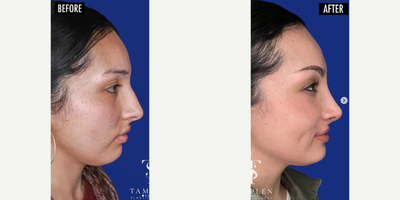 Woman treated with Rhinoplasty - Beautiful results just 3 months after open #rhinoplasty.This patient wanted a more well defined, slightly sloped nose that fit her face and that is exactly what she got. Couldnt be happier!