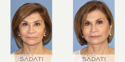 Facelift Revision on Female by Dr. Kevin Sadati - Female revision facelift procedure on 55 - 64 yr old Newport Beach resident performed by Orange County facial plastic surgeon Dr. Kevin Sadati