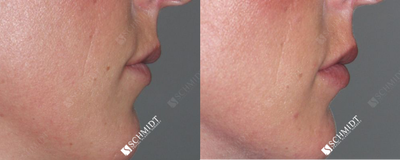 Woman treated with Juvederm - She needed a total of two syringes of JuvdermUltra Plus to make a significant difference relative to the volume she already had. The Juvdermwas placed within the vermillion  the pink portions of the lip  as well as in the areas above and below the vermillion.