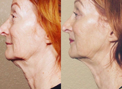 65-74 year old woman treated with Secret RF - Secret Rf for neck tightening and rejuvenation. Patient completed 3 treatments spaced one month apart.