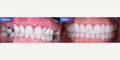 Man treated with Porcelain Veneers, Dental Implants - Man treated with Porcelain Veneers, Dental Implants